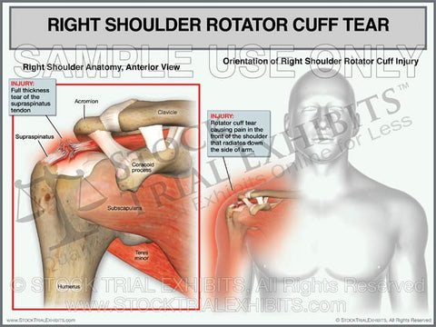 Rotator Cuff Tear Medical Illustrations and Stock Exhibits