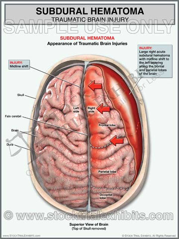 Brain Injury Medical Exhibit Subdural Hematoma 