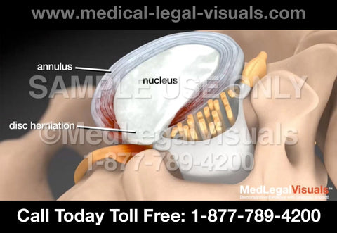 Medical Legal Animation - Disc Herniation with Radiculopathy