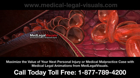 medical legal animations and medical legal illustrations from Medical Legal Visuals