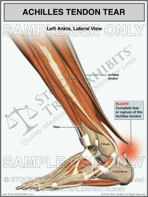 Achilles Tendon Tear of the Left Ankle – Stock Trial Exhibits