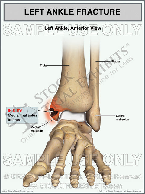 left lateral malleolus fracture