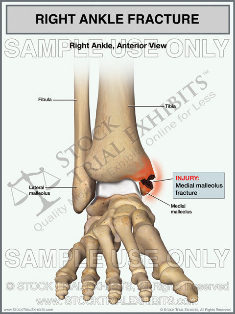 pain intermittently lateral malleolus fracture