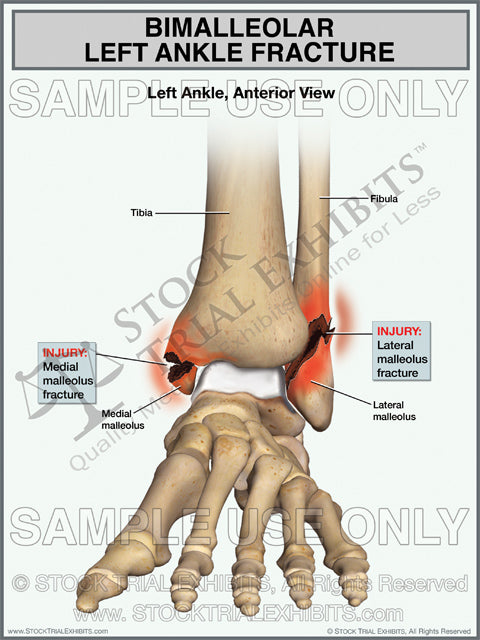 bimalleolar fracture