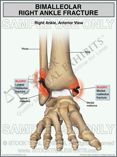 fracture pictures cost