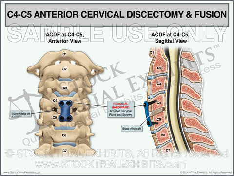 C4 C5 ACDF TrialExhibit 1024x1024 ?v=1494986356