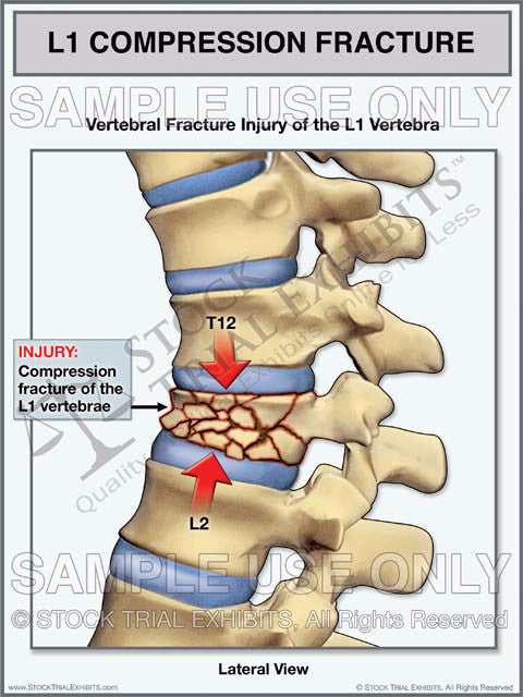 acute l1 compression fracture treatment