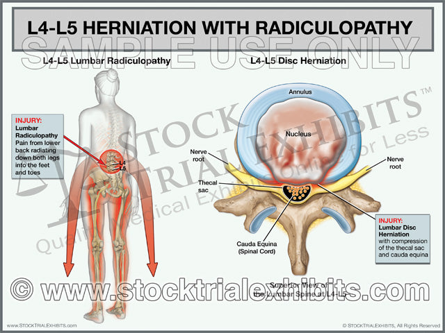 L4 L5 Herniation With Radiculopathy Female Stock Trial Exhibits