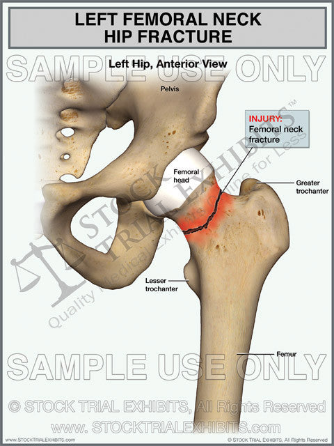 femoral neck fracture symptoms