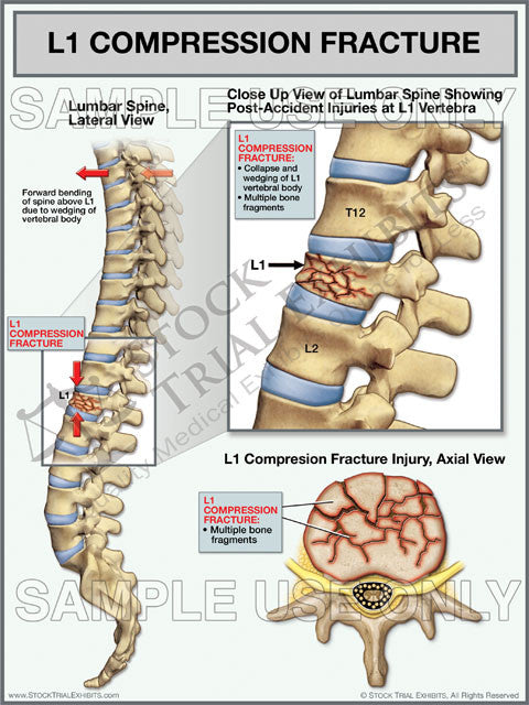 Lumbar Spine L1 Compression Fracture Trial Exhibit Stock Trial Exhibits