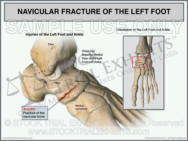 walking on a navicular fracture