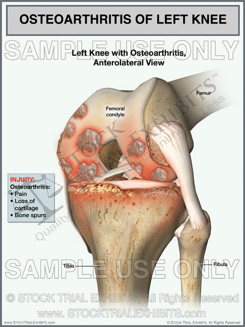 Osteoarthritis Of The Left Knee Stock Trial Exhibits 9580