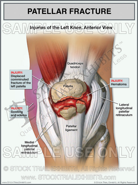 left patella