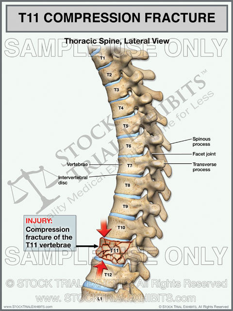 compression fracture thoracic spine