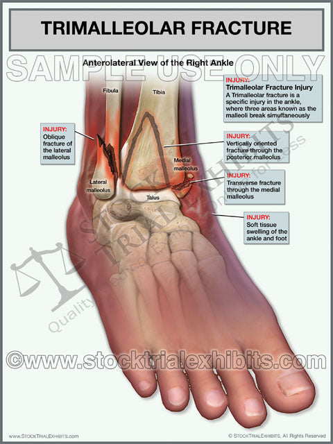 Trimalleolar Fracture Of Right Ankle Stock Trial Exhibits 8719