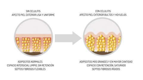 gráfico comparativo de una piel con y sin celulitis