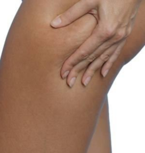 Tratamientos anti celulitis que funcionan