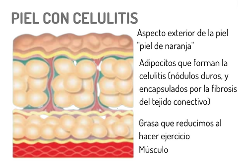 en el gráfico se representa la piel con celulitis, donde el tejido extracelular alrededor de los adipocitos se ha saturado provocando que éstos aumenten en tamaño y cantidad congestionando el tejido. El tejido conectivo pierde la elasticidad y se endurece, y se produce la fibrosis que encapsula los nódulos. 