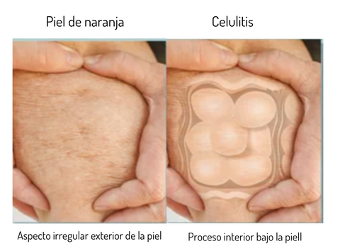 comparación entre piel de naranaja (aspecto irregular exterior de la piel) y la celulitis, que ocurre en las capas más profundas de la piel