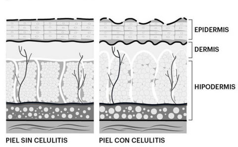 formacion de la celulitis antes y despues