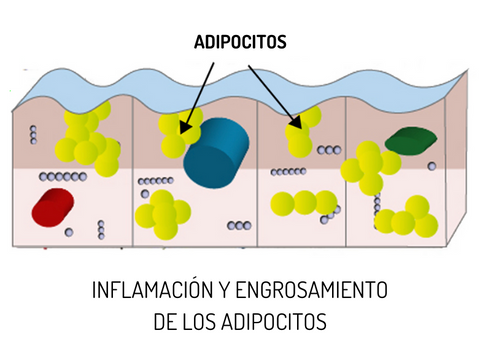 los adipocitos se hipertrofian formando la celulitis