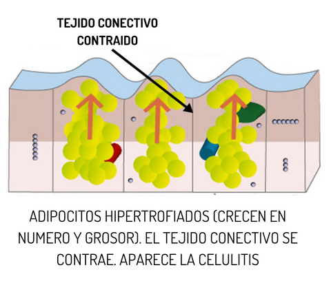 la formacion de la piel de naranja, en las fases de la celulitis