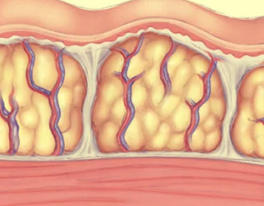 representación de la celulitis bajo la piel