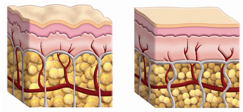 Piel con y sin celulitis