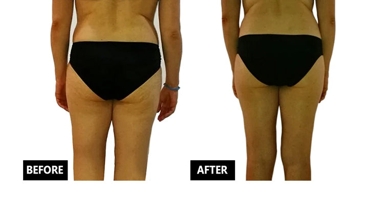 Anti-cellulite Appliances at Home: Goodbye Cellulite and Flabbiness