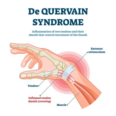 A diagram depicting De Quervain Syndrome, one of the many answers to the question of, "Why does my wrist crack when I rotate it?"