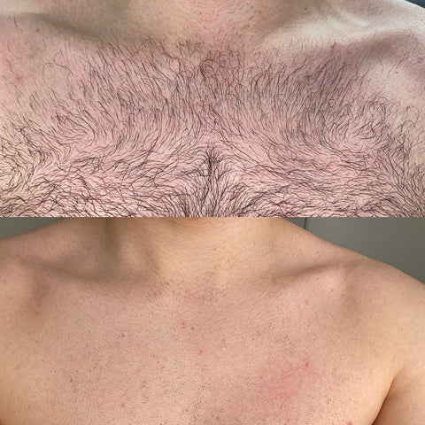 before and after of ipl hair removal