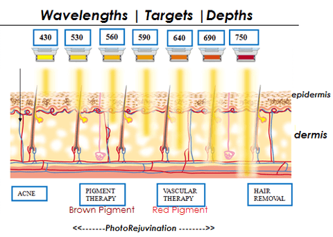 Intense pulsed light