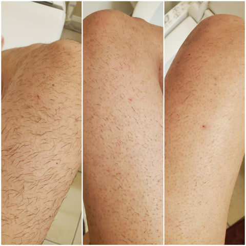 bosidin hair removal before and after