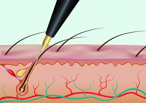 electrolysis hair removal