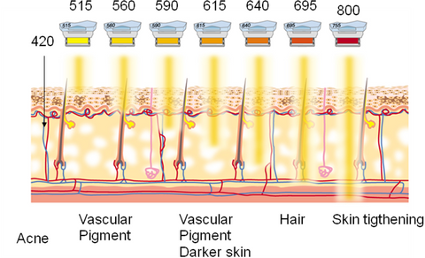 ipl hair removal wavelength