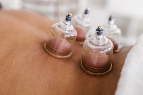 four cupping cups on a patients back.