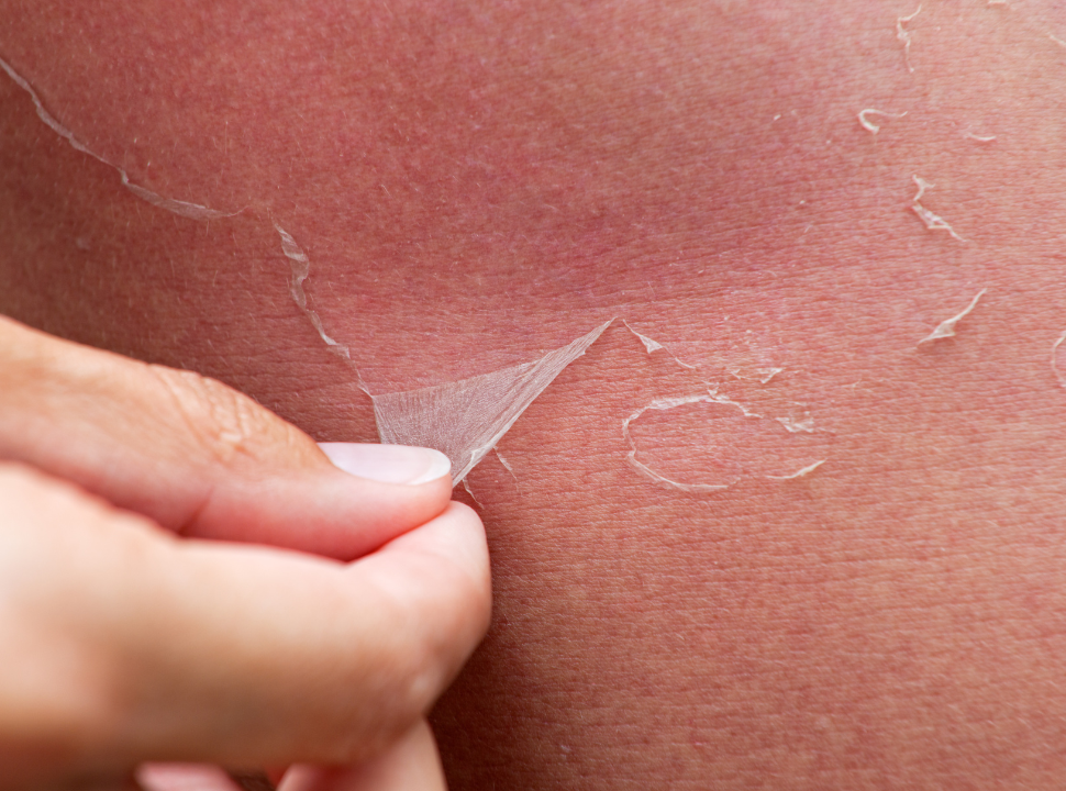 sunburn-peeling-dos-and-don'ts-mdglam