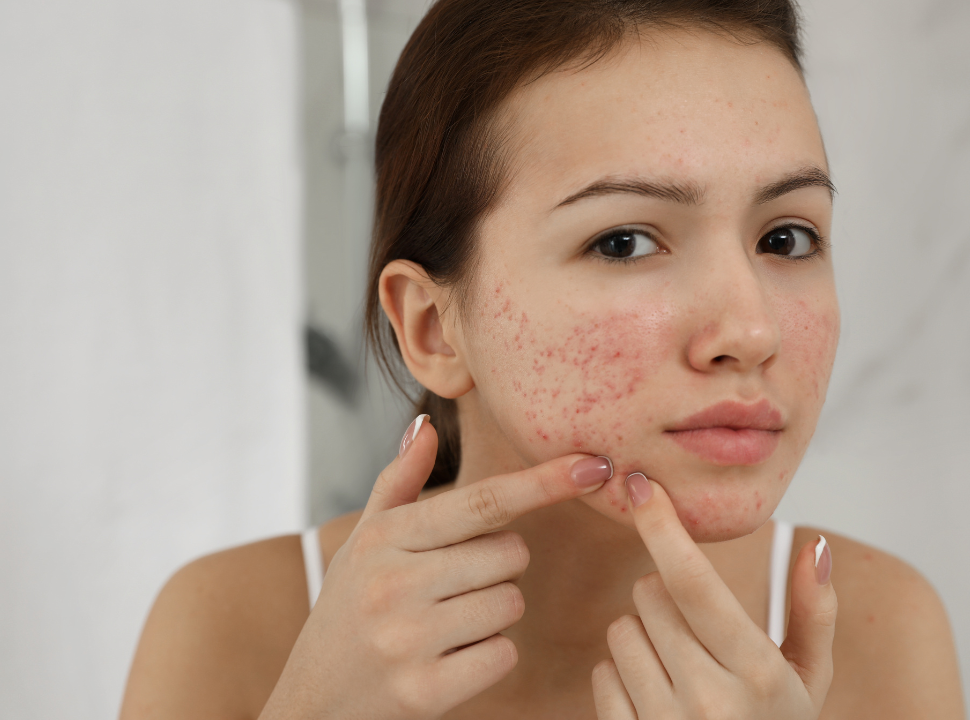 acne-prone-skin