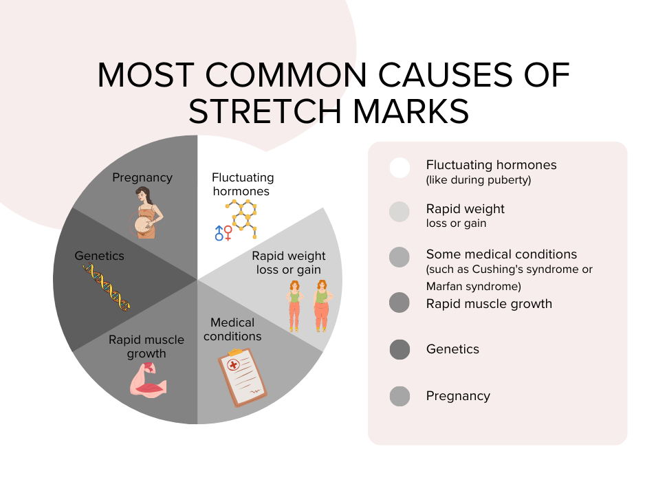 common-causes-of-stretch-marks
