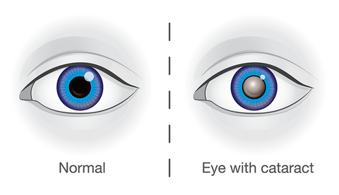 eye with and without cataract 