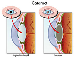 Healthy eye and eye with cataract
