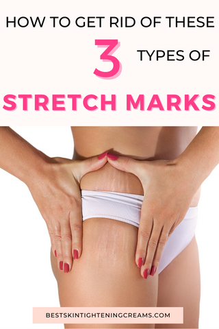 Best Stretch Mark Cream