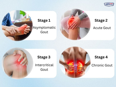 Stages of Hyperuricemia