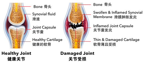 Healthy & Damaged Joint——B-02.png__PID:713cd630-89ad-46eb-950b-70e0d91c90c9