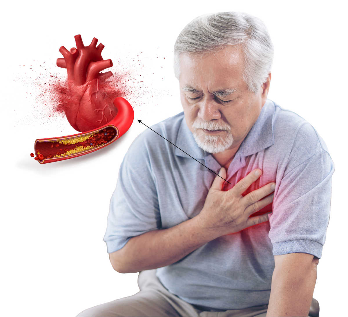 Treating older adults with clogged arteries