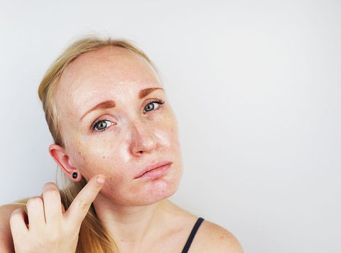 adult acne treatment 