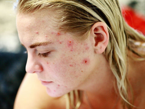 acne treatment 