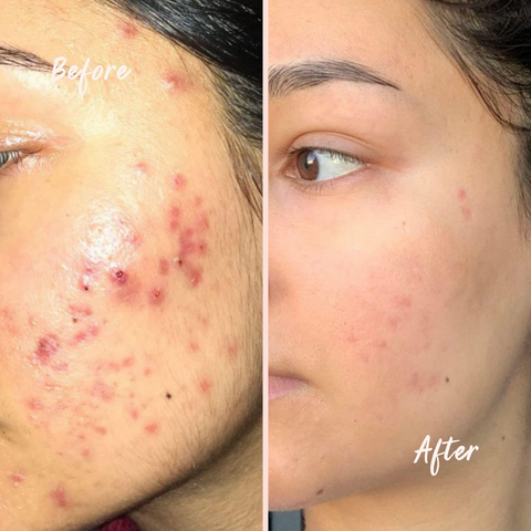 Acne transformation before and after