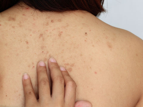 How to get rid of back acne fast 