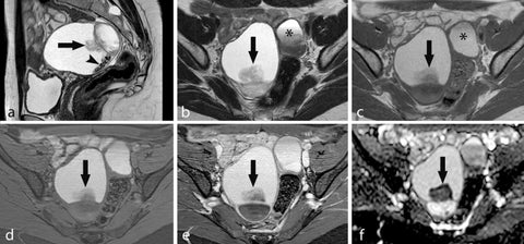 deep pelvic endometriosis